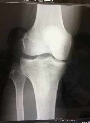 右膝のレントゲン写真